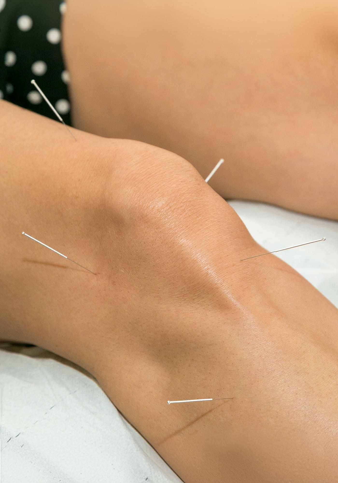 Acupuncteur Ste-Julie
