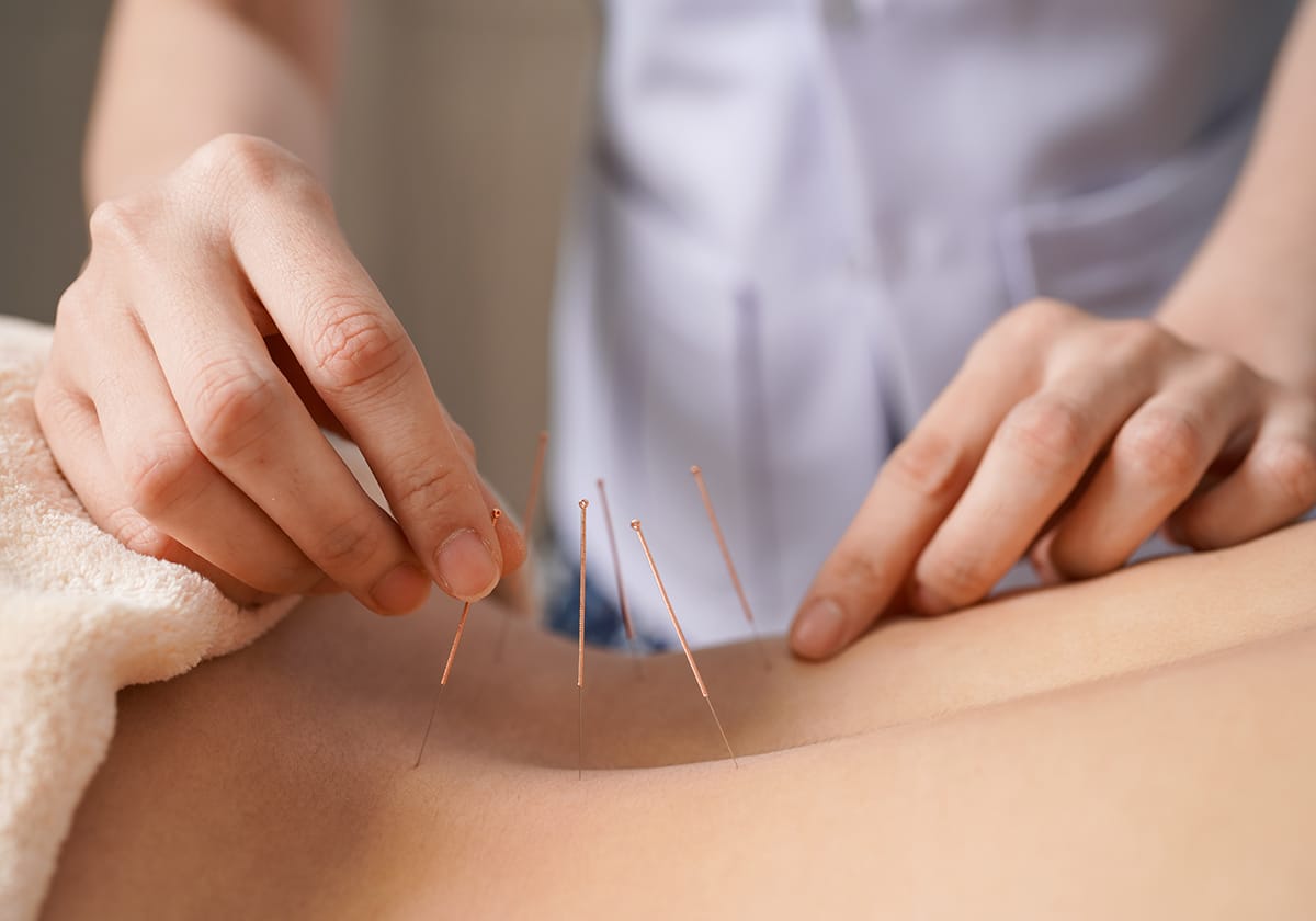Acupuncture près de Ste-Julie